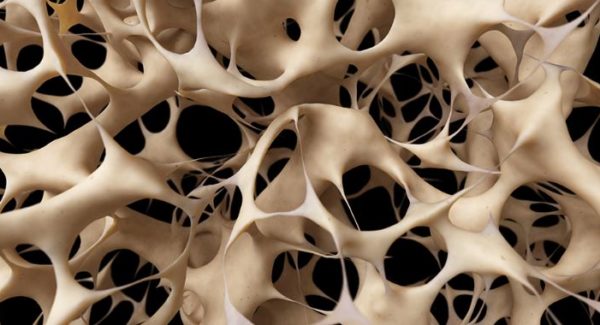 Beating Osteoporosis education