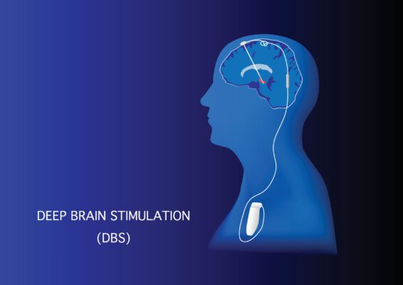 Parkinson's Disease Deep Brain Simulation